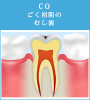 COごく初期のむし歯