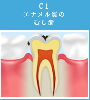 C1エナメル質のむし歯