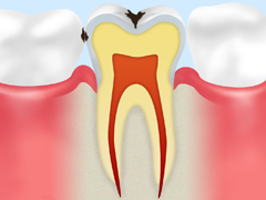 C1 　エナメル質のむし歯