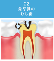 C2象牙質のむし歯