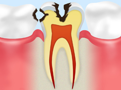 C2 　象牙質のむし歯