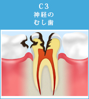 C3神経のむし歯