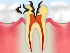 C3 　神経のむし歯