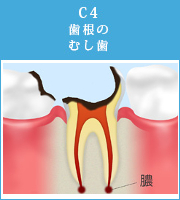 C4歯根のむし歯