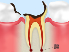 C4 　歯根のむし歯