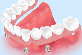 インプラントオーバーデンチャー