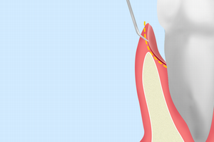 歯周ポケット掻爬（そうは）